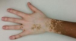 auto immune vitiligo